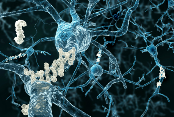 illustration of neurons with amyloid plaques